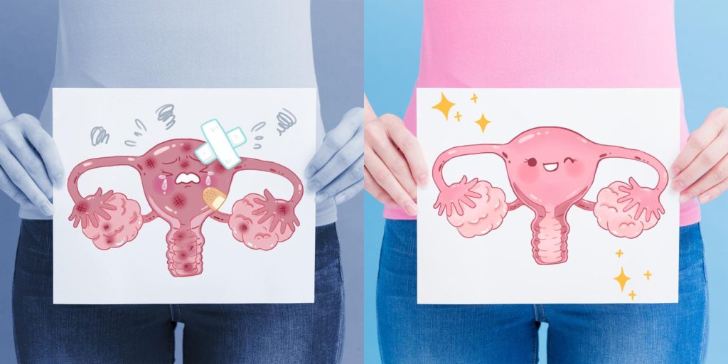 Cáncer de ovario